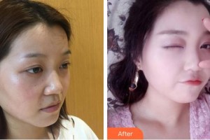 綿陽中心醫(yī)院醫(yī)學美容科趙平武整形價格表附鼻部綜合案例展示