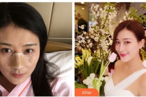 綿陽中心醫(yī)院醫(yī)學美容科杜永忠整形價格表附鼻部綜合案例展示