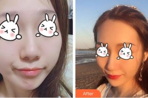 綿陽中心醫(yī)院醫(yī)學美容科劉小意整形價格表附無針水光案例展示