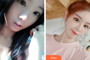 深圳吳小兵醫(yī)療美容診所吳小兵整形價(jià)格表附雙眼皮案例展示