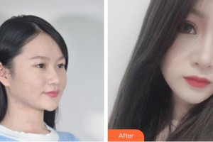 綿陽茗匯醫(yī)療美容醫(yī)院裴亮整形價格表附眼部綜合案例展示