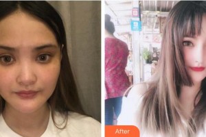 綿陽東美奧拉克醫(yī)療美容門診部盧元剛整形價格表附耳軟骨復合隆鼻案例展示