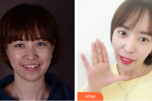 深圳友睦口腔門診部陳鋼整形價(jià)格表附時(shí)代天使隱形矯正案例展示