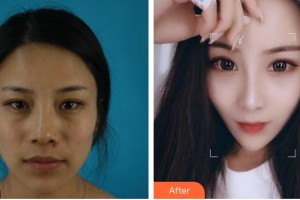 綿陽東美奧拉克醫(yī)療美容門診部鄒佳整形價格表附肋軟骨隆鼻案例展示