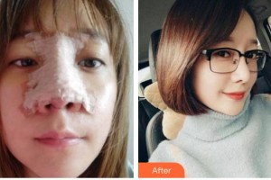 綿陽東美奧拉克醫(yī)療美容門診部周雪整形價格表附鼻部綜合案例展示