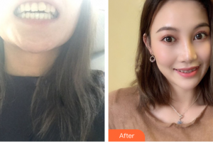 深圳友睦口腔門診部時(shí)春宇整形價(jià)格表附半隱形矯正案例展示