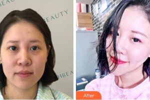 綿陽愛爾眼科醫(yī)院王曉莉整形價格表附熱瑪吉案例展示