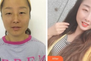 綿陽愛爾眼科醫(yī)院周晶蓉整形價格表附內(nèi)切祛眼袋案例展示