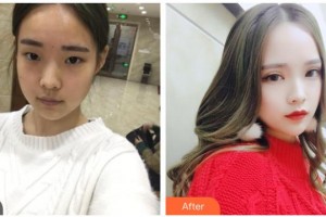 綿陽愛爾眼科醫(yī)院趙定中整形價格表附切開雙眼皮案例展示