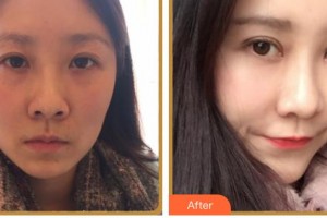 綿陽愛爾眼科醫(yī)院蘇林整形價格表附眼部綜合案例展示