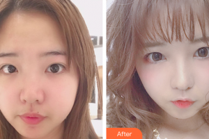 深圳心悅醫(yī)療美容門診部劉曉明整形價(jià)格表附眼部整形案例展示