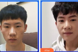 綿陽愛爾眼科醫(yī)院魯齊整形價格表附切開雙眼皮案例展示