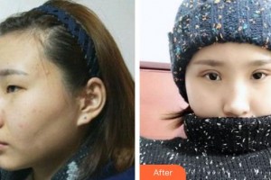 綿陽愛爾眼科醫(yī)院石玉萍整形價格表附切開雙眼皮案例展示