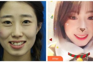 綿陽獨(dú)言口腔門診部獨(dú)言整形價格表附金屬托槽矯正案例展示