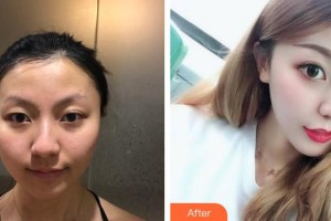 綿陽萬江眼科醫(yī)院張由良整形價格表附上眼瞼去脂案例展示