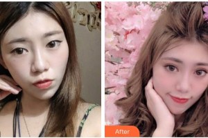 廣元美華醫(yī)學(xué)美容診所楊林整形價格表附眼部綜合案例展示