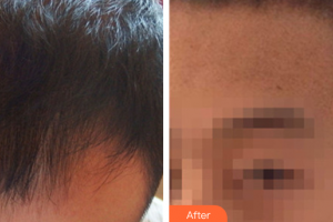 深圳華悅醫(yī)療美容門診部宋金錫整形價(jià)格表附種植發(fā)際線案例展示