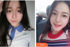 廣元朗睿整形美容醫(yī)院劉剛整形價格表附切開雙眼皮案例展示