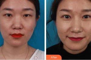 廣元市利州區(qū)中醫(yī)醫(yī)院眼科李圣住院醫(yī)師整形價格表附切開雙眼皮案例展示