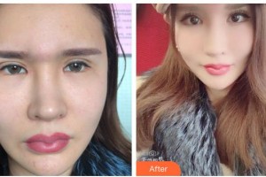 廣元市利州區(qū)中醫(yī)醫(yī)院眼科李宣整形價格表附眼部修復(fù)案例展示