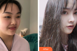 深圳建安醫(yī)療美容門診部李天石整形價格表附眼部手術(shù)+鼻部綜合案例展示