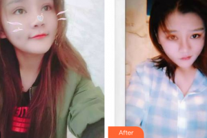 深圳建安醫(yī)療美容門診部彭一純整形價(jià)格表附牙齒隱形矯正案例展示