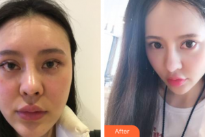 深圳福華醫(yī)療美容醫(yī)院陳貞宜整形價格表附埋線提升案例展示