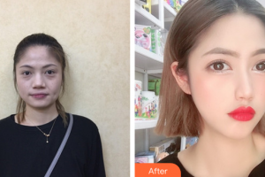 深圳格美醫(yī)療美容診所李英整形價格表附埋線提升案例展示