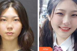 深圳陽光整形美容醫(yī)院陳星光整形價格表附鼻部多項(xiàng)案例展示