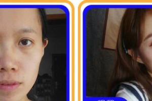 廣元市第三人民醫(yī)院眼科胡開東整形價格表附眼部綜合案例展示