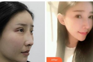 廣元市中心醫(yī)院眼科王軍整形價(jià)格表附切開雙眼皮案例展示