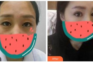 廣元萬(wàn)江眼科醫(yī)院董萬(wàn)江整形價(jià)格表附切開雙眼皮案例展示