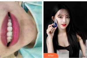 廣元口腔醫(yī)院董世林整形價(jià)格表附牙齒隱形矯正案例展示