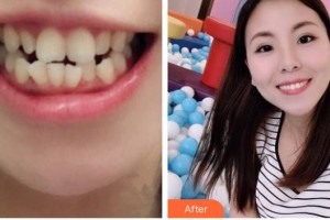 廣元口腔醫(yī)院王瑋整形價(jià)格表附金屬托槽矯正案例展示