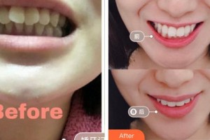 廣元口腔醫(yī)院張孝華整形價(jià)格表附牙齒隱形矯正案例展示