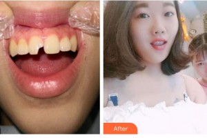 廣元口腔醫(yī)院陳遠(yuǎn)禮整形價(jià)格表附美白貼片案例展示