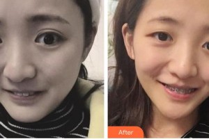 廣元口腔醫(yī)院王朝宇整形價(jià)格表附金屬托槽矯正案例展示