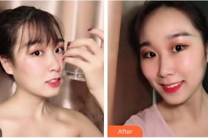 廣元口腔醫(yī)院馬林整形價(jià)格表附牙齒隱形矯正案例展示