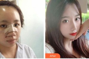 遂寧市康博醫(yī)學(xué)美容診所常太平整形價(jià)格表附鼻部綜合案例展示