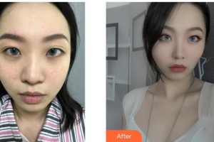 遂寧市中心醫(yī)院燒傷整形科劉唯住院醫(yī)師整形價(jià)格表附鼻翼縮小案例展示