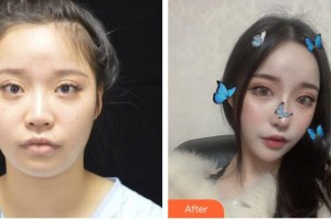 遂寧市中心醫(yī)院燒傷整形科高錦越整形價(jià)格表附肋軟骨隆鼻案例展示