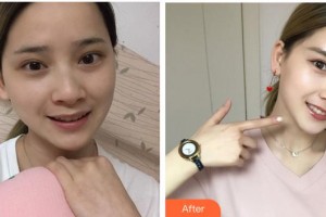 遂寧市中心醫(yī)院燒傷整形科羅長(zhǎng)生整形價(jià)格表附鼻部綜合案例展示