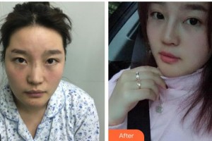 遂寧市中心醫(yī)院燒傷整形科王國(guó)昌整形價(jià)格表附鼻部手術(shù)案例展示