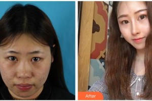 遂寧市中心醫(yī)院燒傷整形科李盛華整形價(jià)格表附肋軟骨隆鼻案例展示