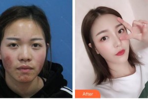 遂寧雙華醫(yī)學(xué)整形美容門診部常雙華整形價(jià)格表附膨體隆鼻案例展示