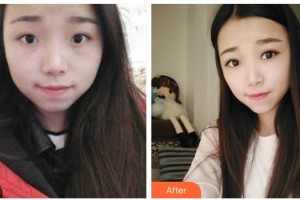 遂寧愛瑞陽(yáng)光眼科醫(yī)院陳銀洪整形價(jià)格表附切開雙眼皮案例展示