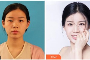 遂寧愛瑞陽(yáng)光眼科醫(yī)院楊云整形價(jià)格表附眼部綜合案例展示