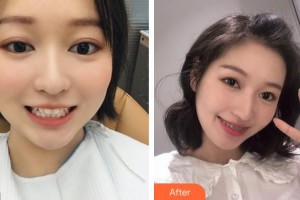 遂寧嘉慧口腔門診部胡婷婷整形價(jià)格表附金屬托槽矯正案例展示