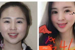 遂寧嘉慧口腔門診部呂海燕整形價(jià)格表附金屬托槽矯正案例展示