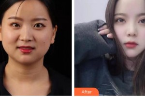 內(nèi)江市中醫(yī)醫(yī)院百合醫(yī)學(xué)美容中心蘭潔整形價(jià)格表附眼部綜合案例展示